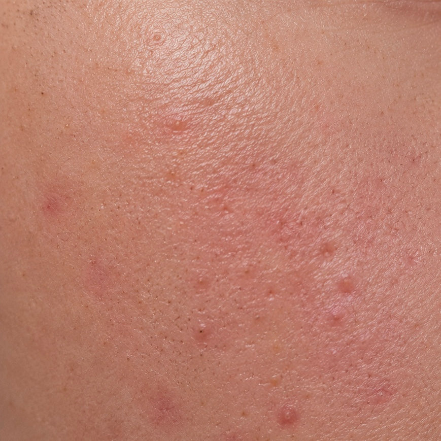 Cosmenia Naturkosmetik für unreine Haut