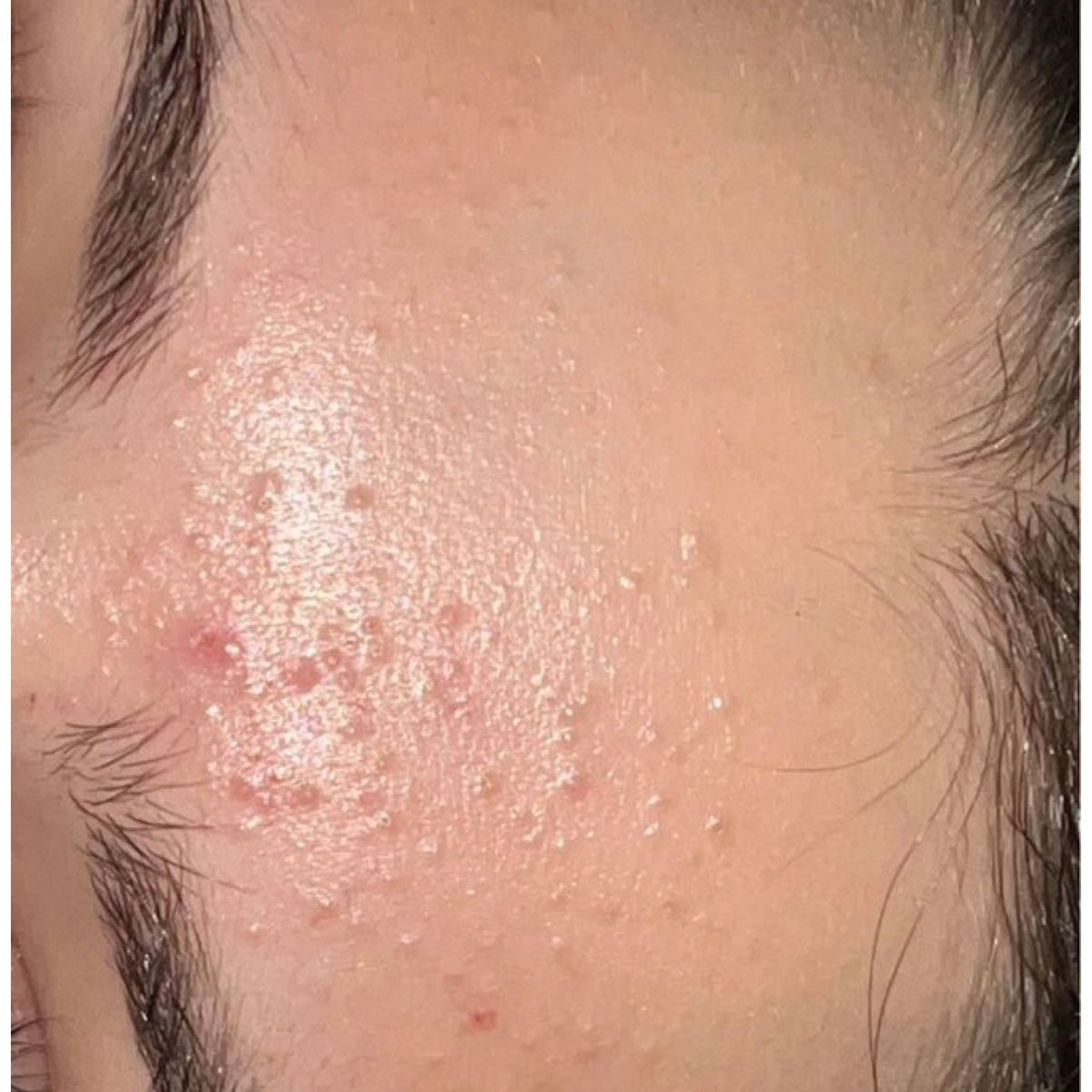Fungal Acne (Malassezia-Follikulitis): Welche Pflege bei pilzbedingten Unreinheiten wirklich hilft